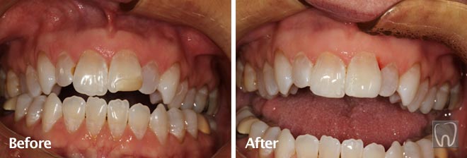 Tooth Whitening and Front Crowns by Black & Black Dental, Willow Street Lancaster PA Pennsylvania dentist